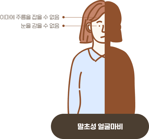 말초성 얼굴마비